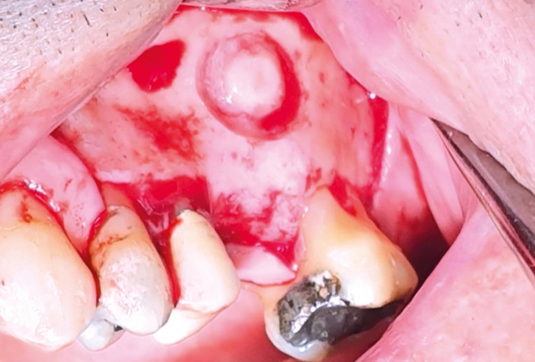 Maxillary sinus cyst removal using the Crocodile Technique and subsequent lateral sinus lift with cerabone®, maxgraft® and Jason® membrane - Dres. C. Scognamiglio and A. Perucchi 