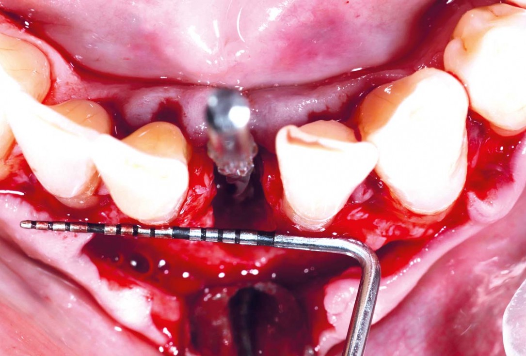 botiss cerabone and mucoderm for bone regeneration and implant supported rehabilitation of a periodontally involved incisor - clinical case