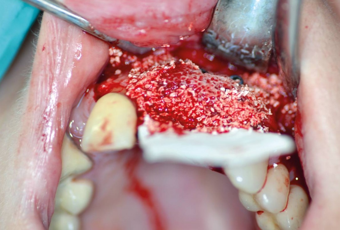 botiss maxgraft® bonebuilder for aesthetic zone reconstruction - Clinical case