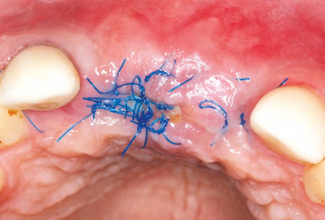 Ridge augmentation in the maxilla with maxgraft® bonebuilder in the aesthetic zone - Dr. M. Kristensen