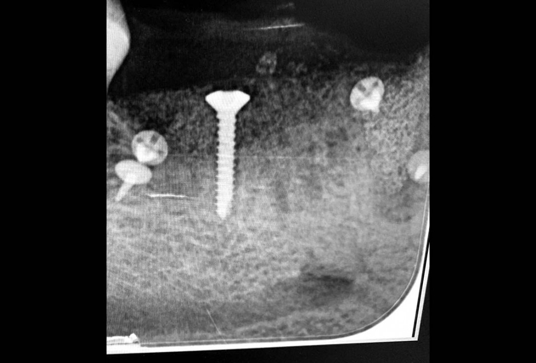Vertical bone augmentation and broadening of attached gingiva using cerabone, permamem and mucoderm  -  Dr. R. Naimoli