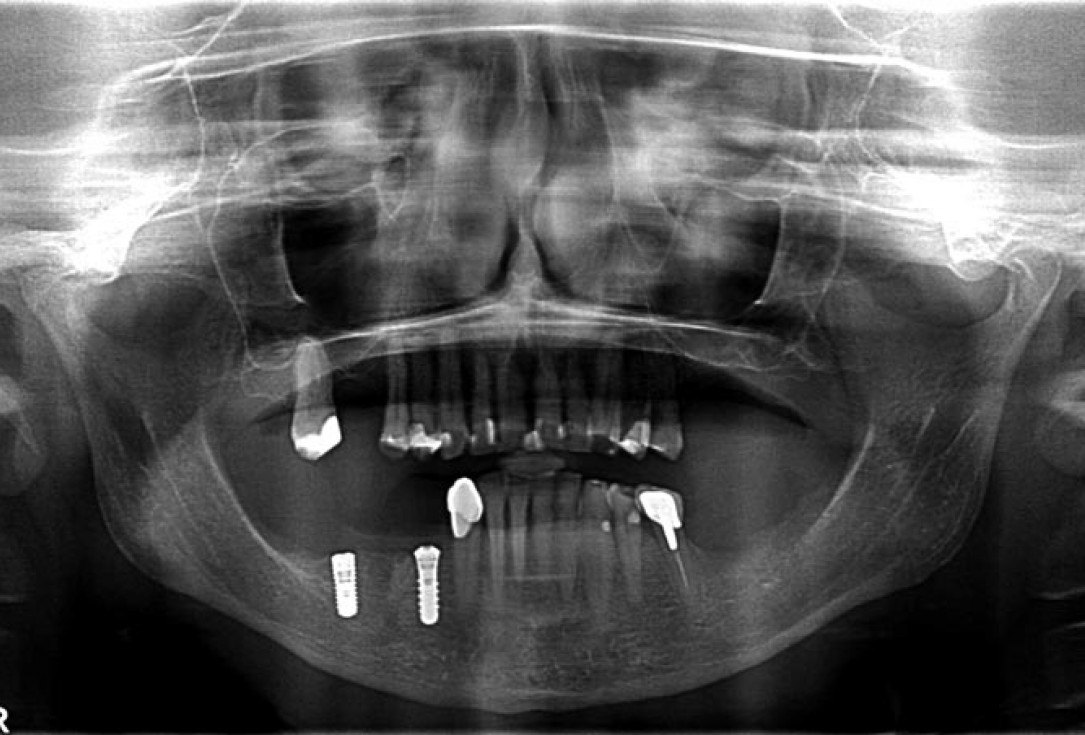 Block augmentation with maxgraft® in the mandible - PD Dr. Dr. F. Kloss