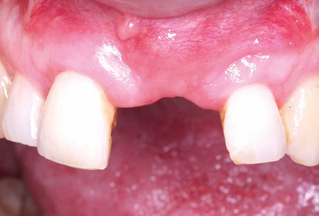 Block grafting in the aesthetic zone with maxgraft®, Jason® membrane and cerabone® - Dres. H. Maghaireh and V. Ivancheva