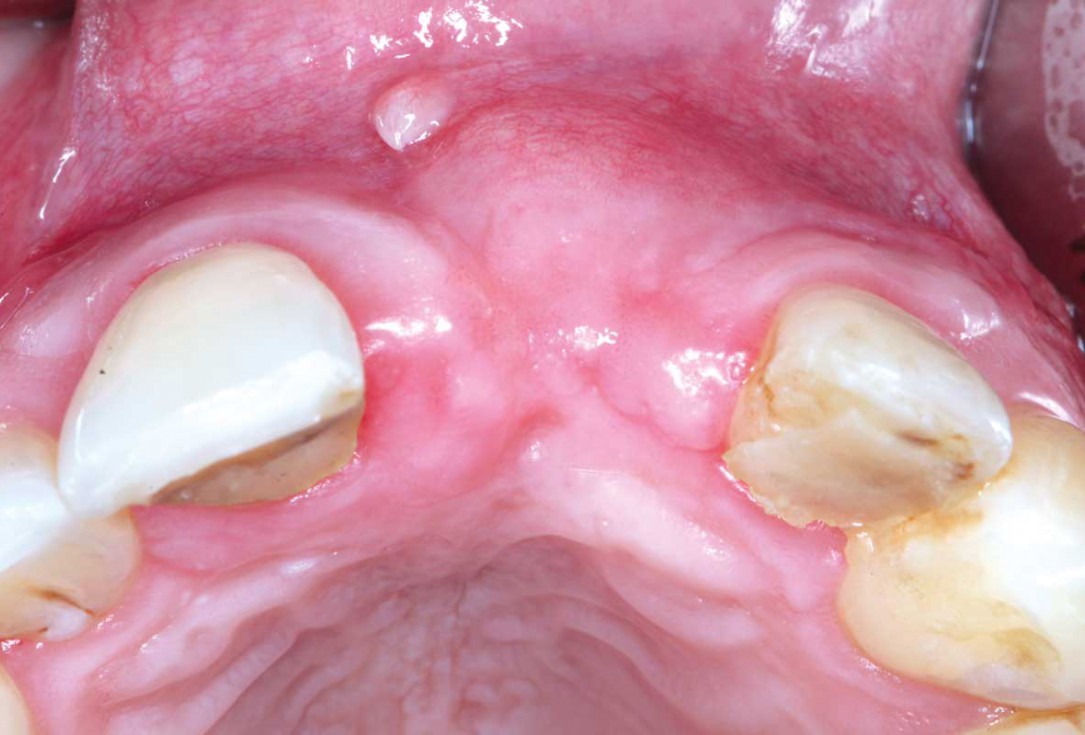 Block grafting in the aesthetic zone with maxgraft®, Jason® membrane and cerabone® - Dres. H. Maghaireh and V. Ivancheva