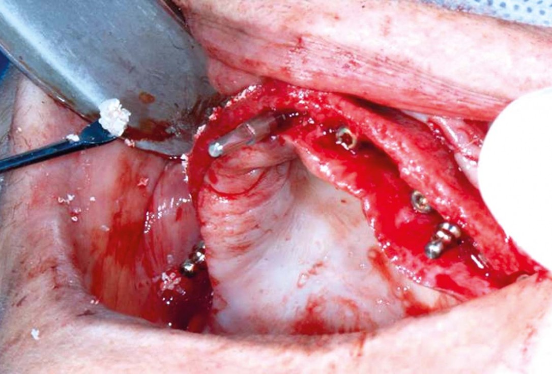 Full arch GBR using botiss cerabone®, maxgraft® and Jason® membrane with simultaneous implantation of 6 Straumann® implants - Dres. A. Signorio and G. Molina