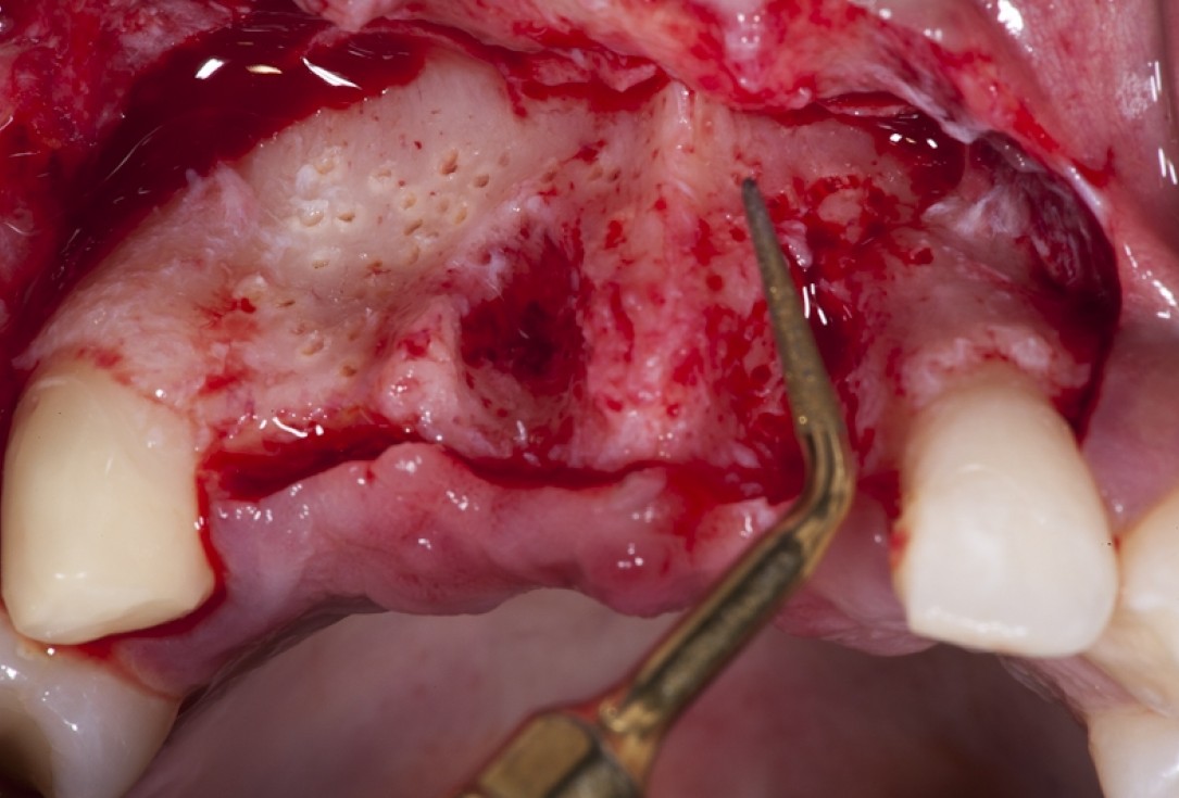 Block augmentation with maxgraft® block and mucoderm® - Dr. K. Chmielewski