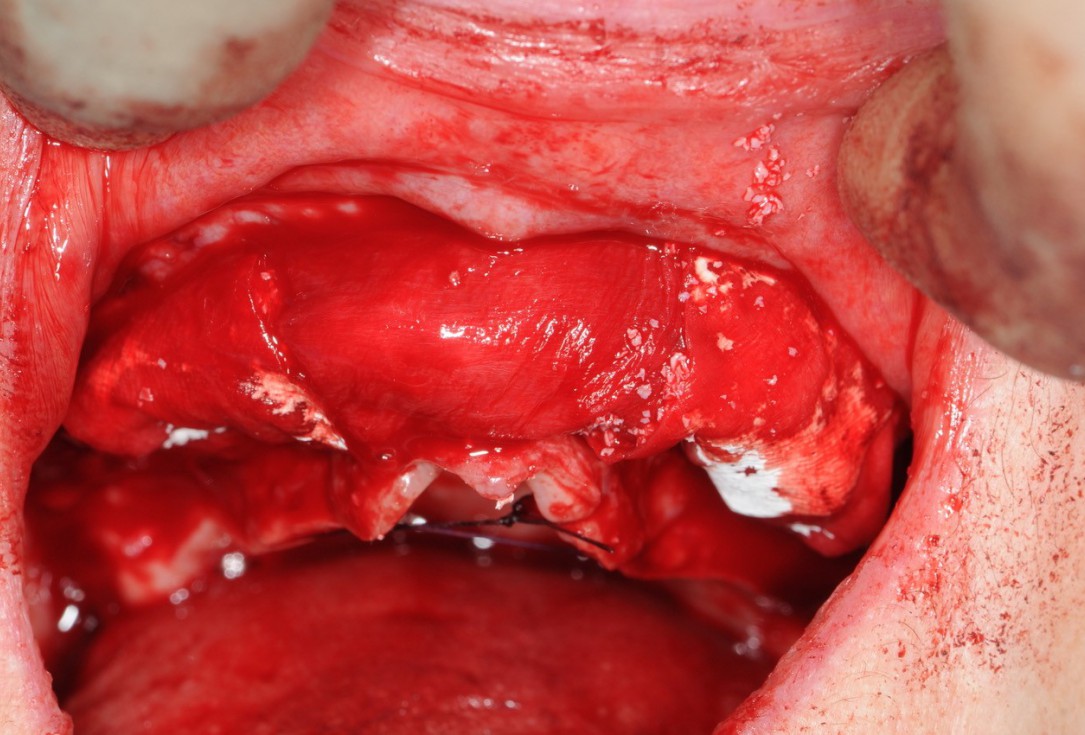 Reconstruction of maxillary ridge with maxgraft® block - Amit Patel