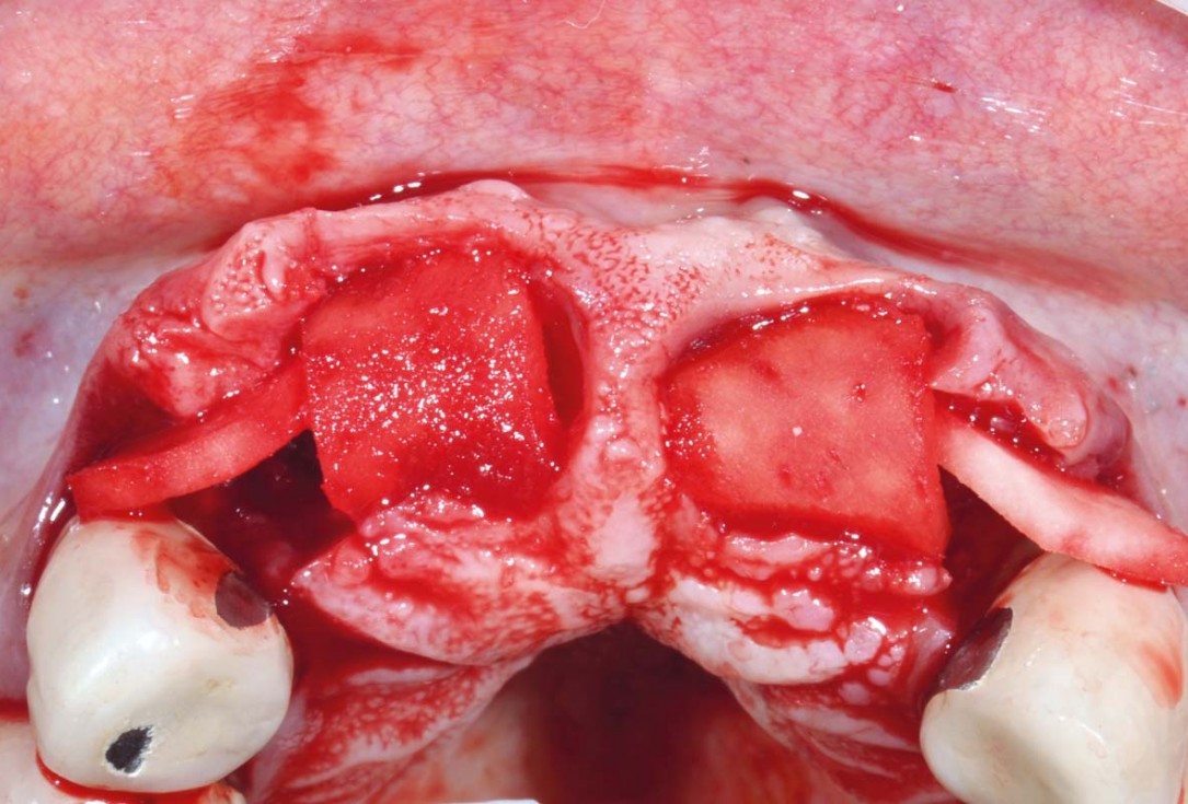 Hard and soft tissue management in immediate restoration