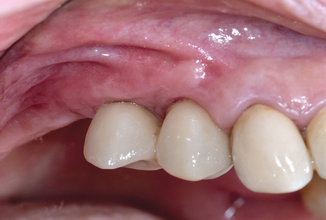 GBR with Jason membrane® and cerabone® - D. Fontana