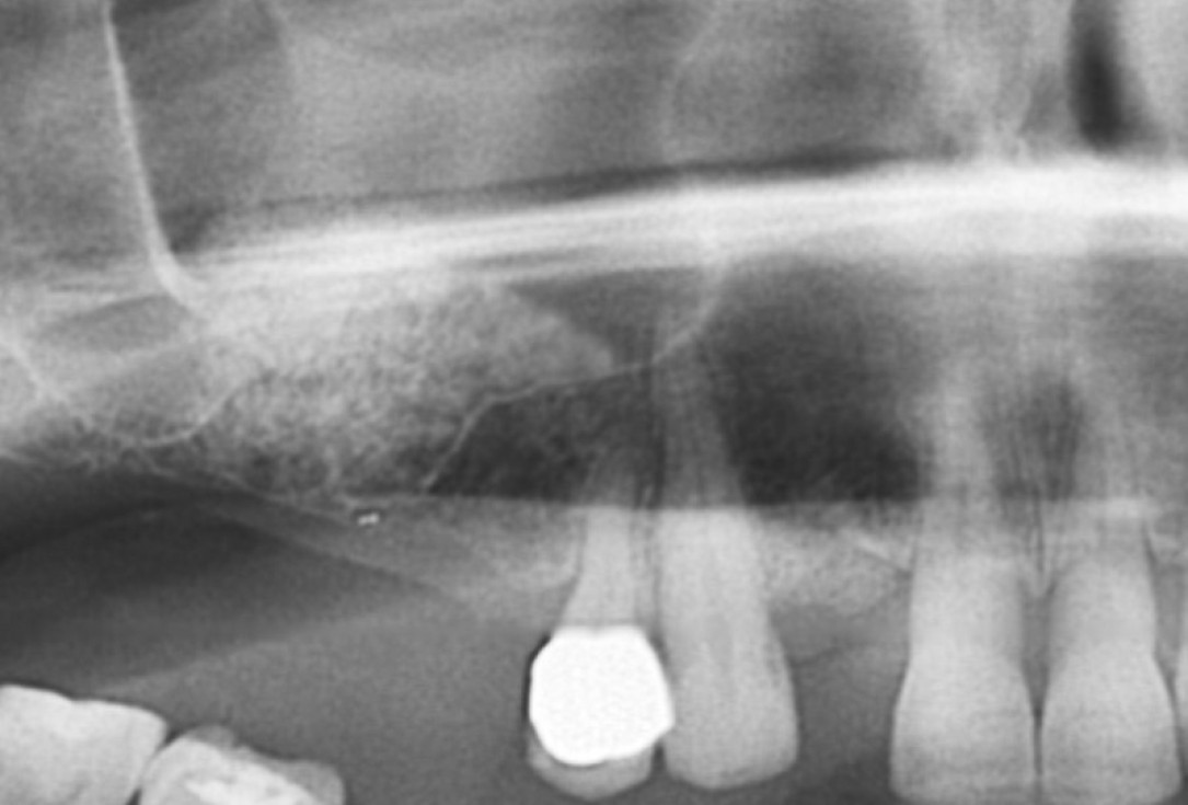 11/20 GBR with maxresorb® and Jason® membrane - Prof. Dr. Dr. D. Rothamel