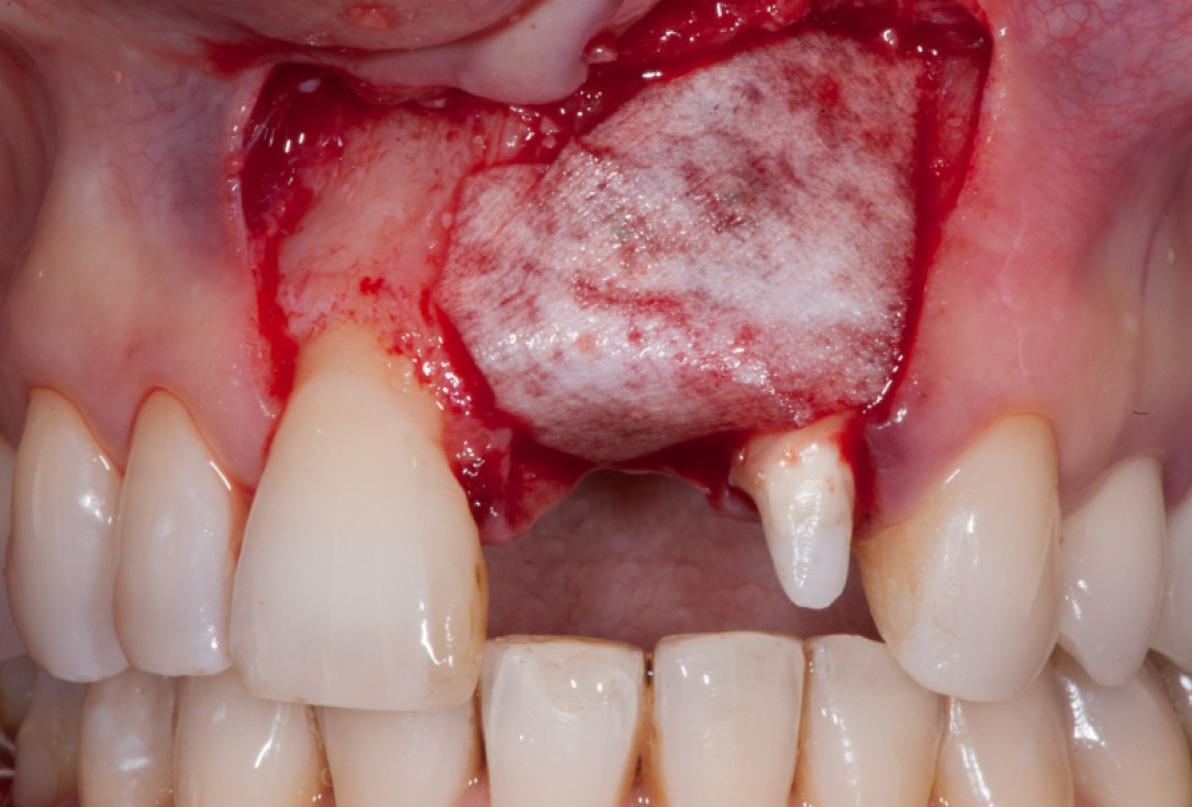 Augmentation with maxgraft® cortico - Dr. K. Chmielewski