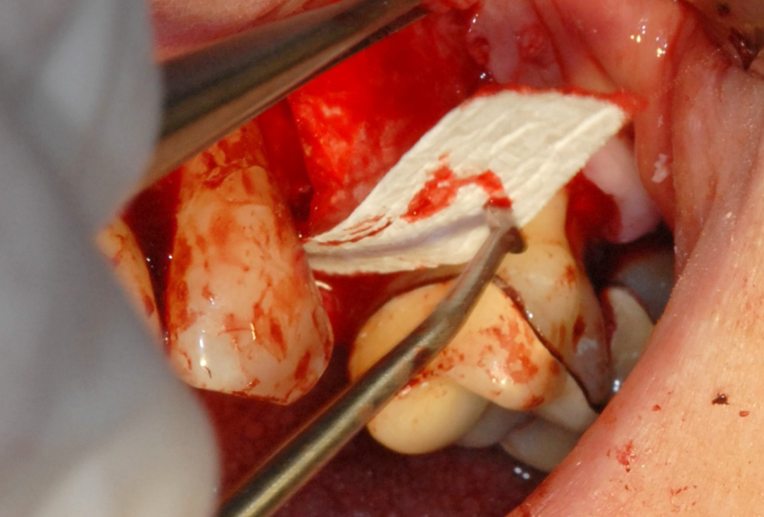 Ridge preservation with cerabone® and Jason® membrane - Dr. Derk Siebers