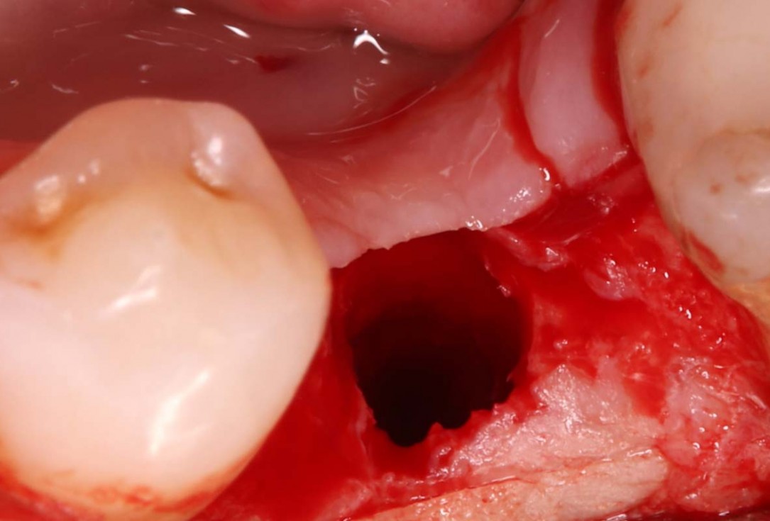 Reconstruction of a single tooth defect with the shell technique - Dr. Andoni Jones