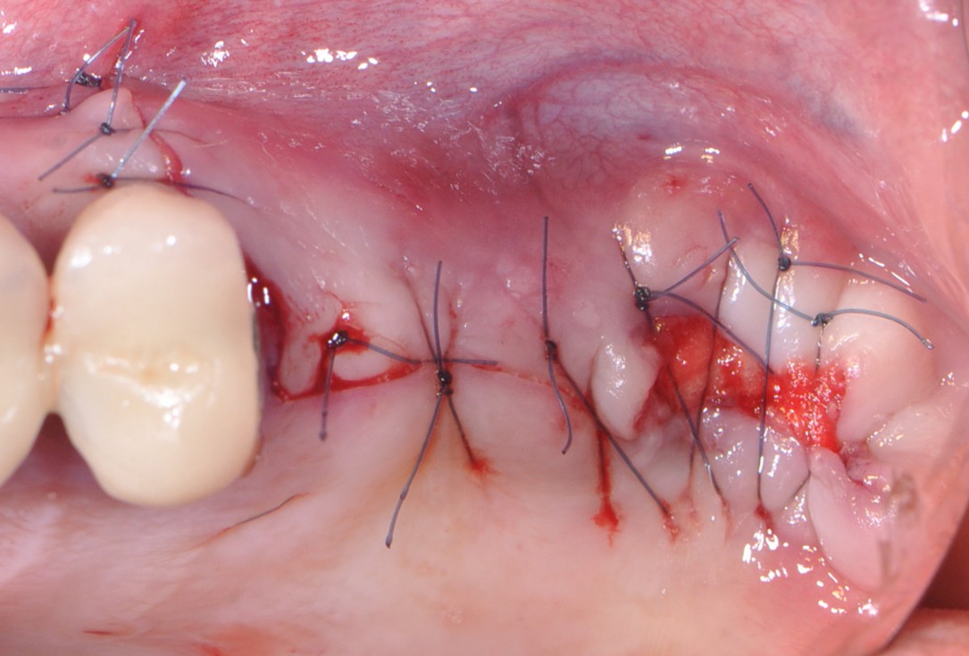 Sinus lift with simultaneous implantation with cerabone® and collprotect® membrane - clinical case Dr. Victor Kalenchuk