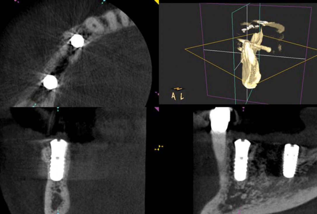 Block augmentation with maxgraft® in the mandible - PD Dr. Dr. F. Kloss