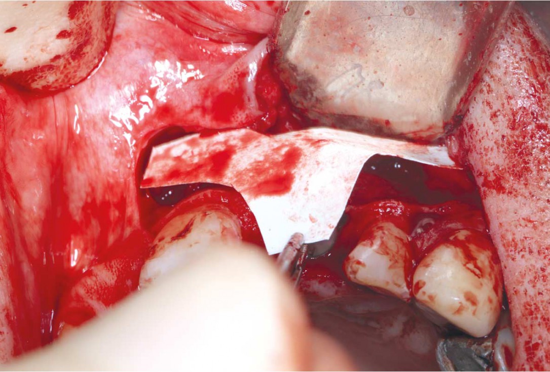 GBR using layering technique in aesthetic zone with maxgraft® and cerabone® -Dr. H. Maghaireh and Dr. V. Ivancheva