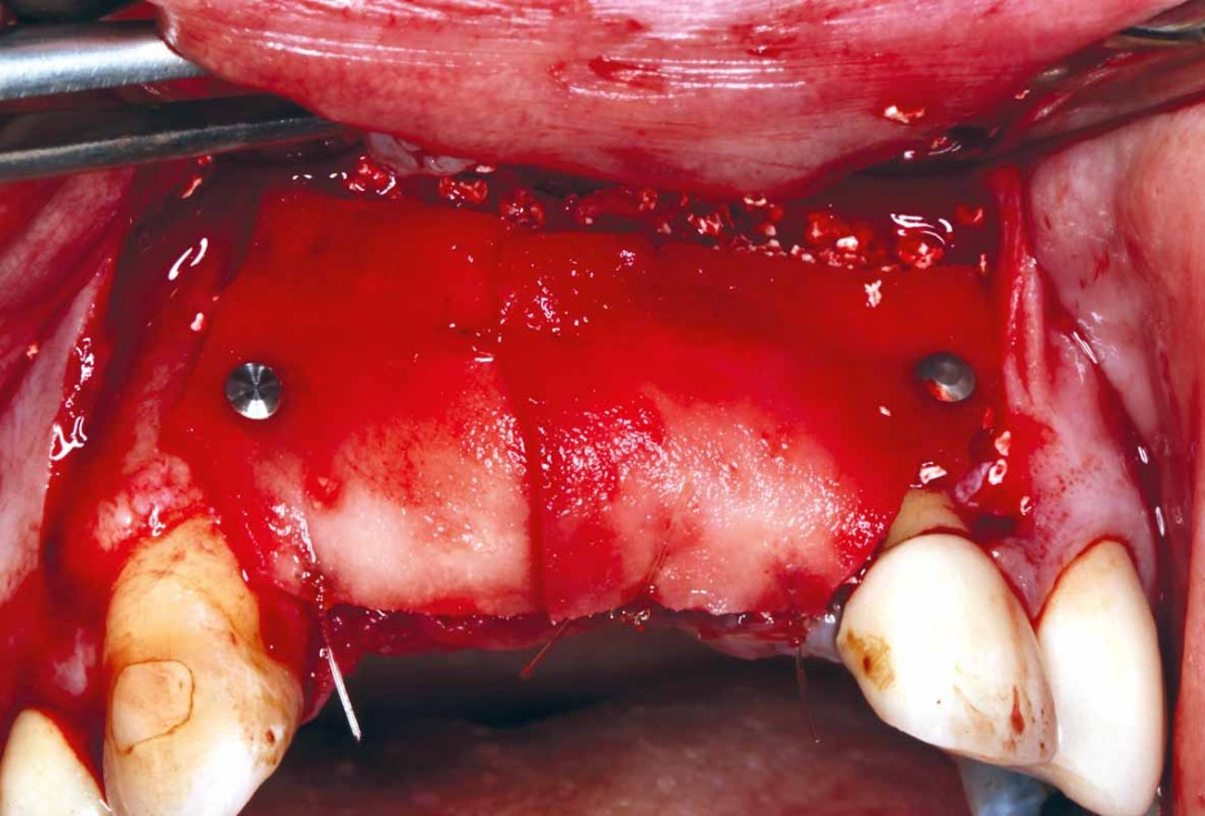 GBR and soft tissue augmentation with cerabone® and mucoderm® - H. Maghaireh & V. Ivancheva