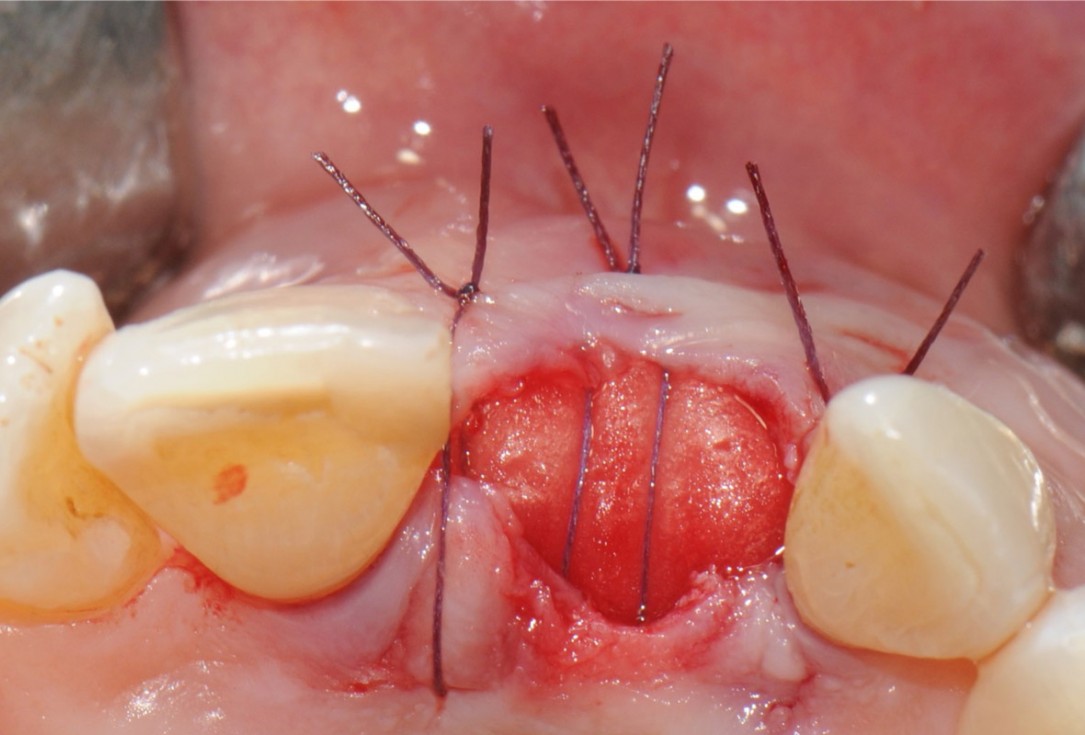 12/18 Tooth extraction and socket sealing with mucoderm® -Dr. A. Rossi