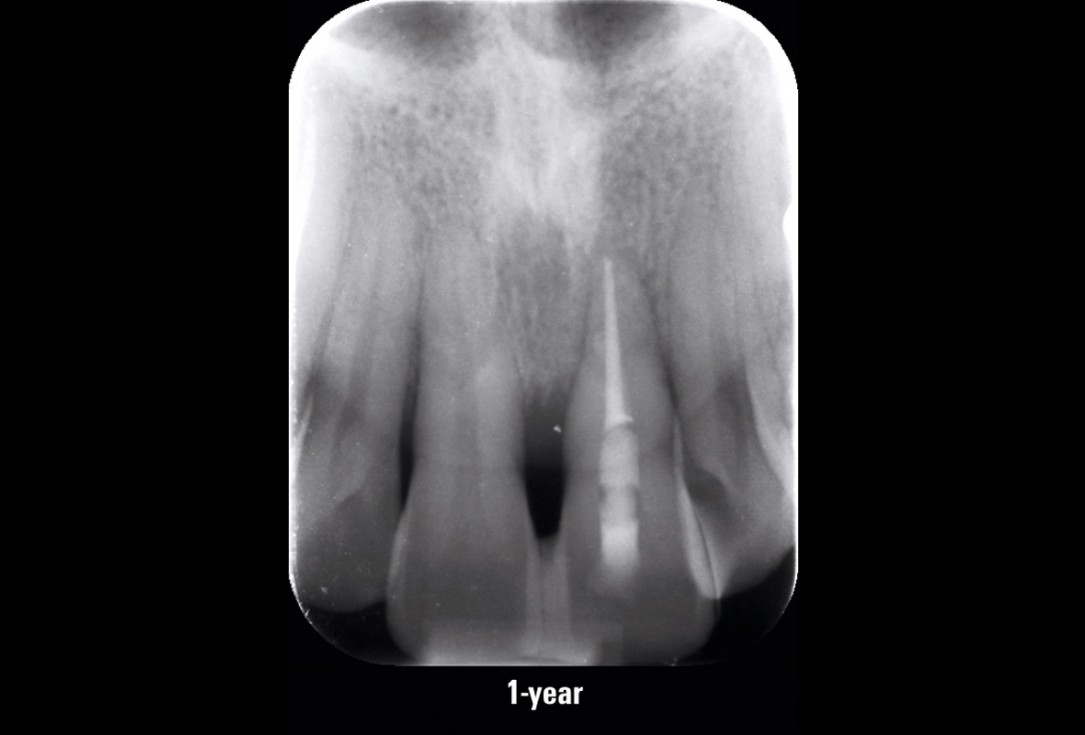 EPP for the treatment of a deep intrabony defect 