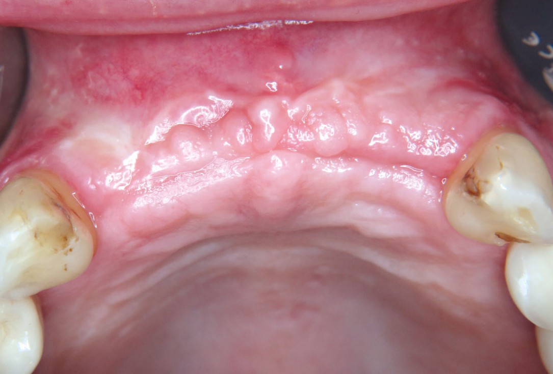 Three-dimensional augmentation with maxgraft® cortico - M.Sc. E. Kapogianni