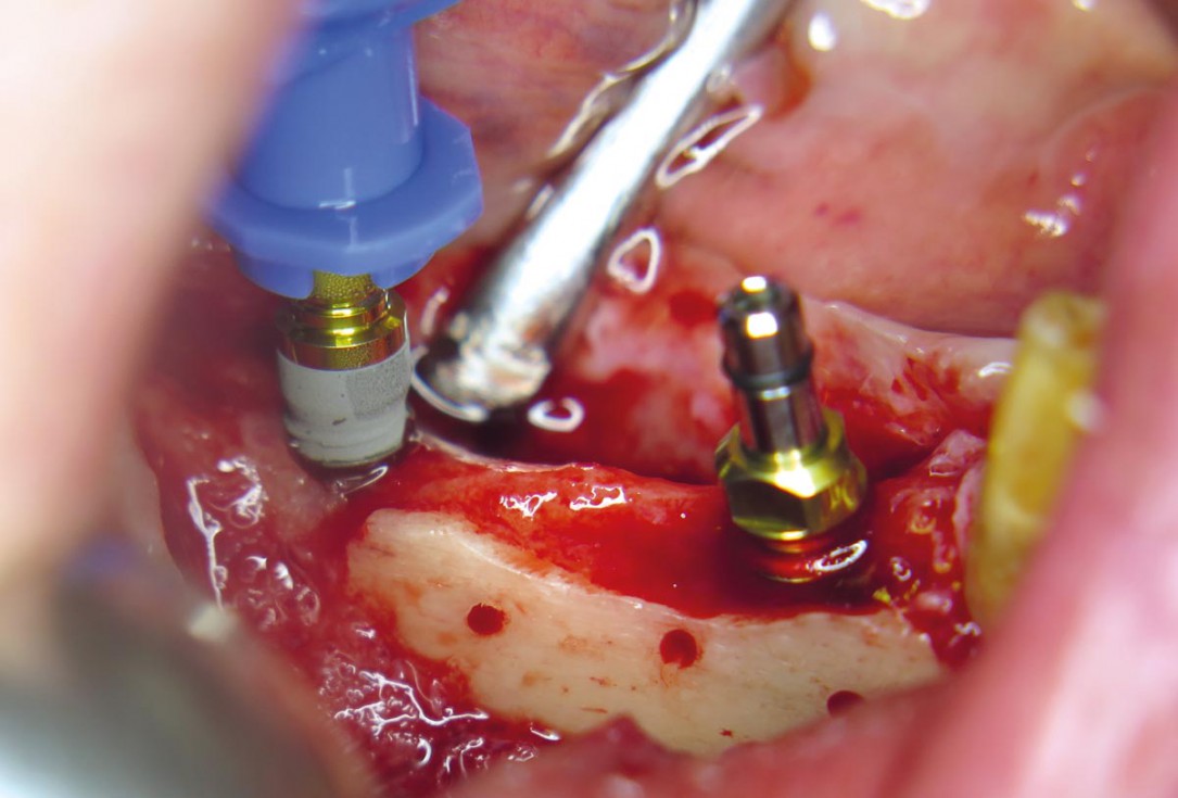 Horizontal ridge augmentation with maxgraft® cortico - M.Sc. E. Kapogianni