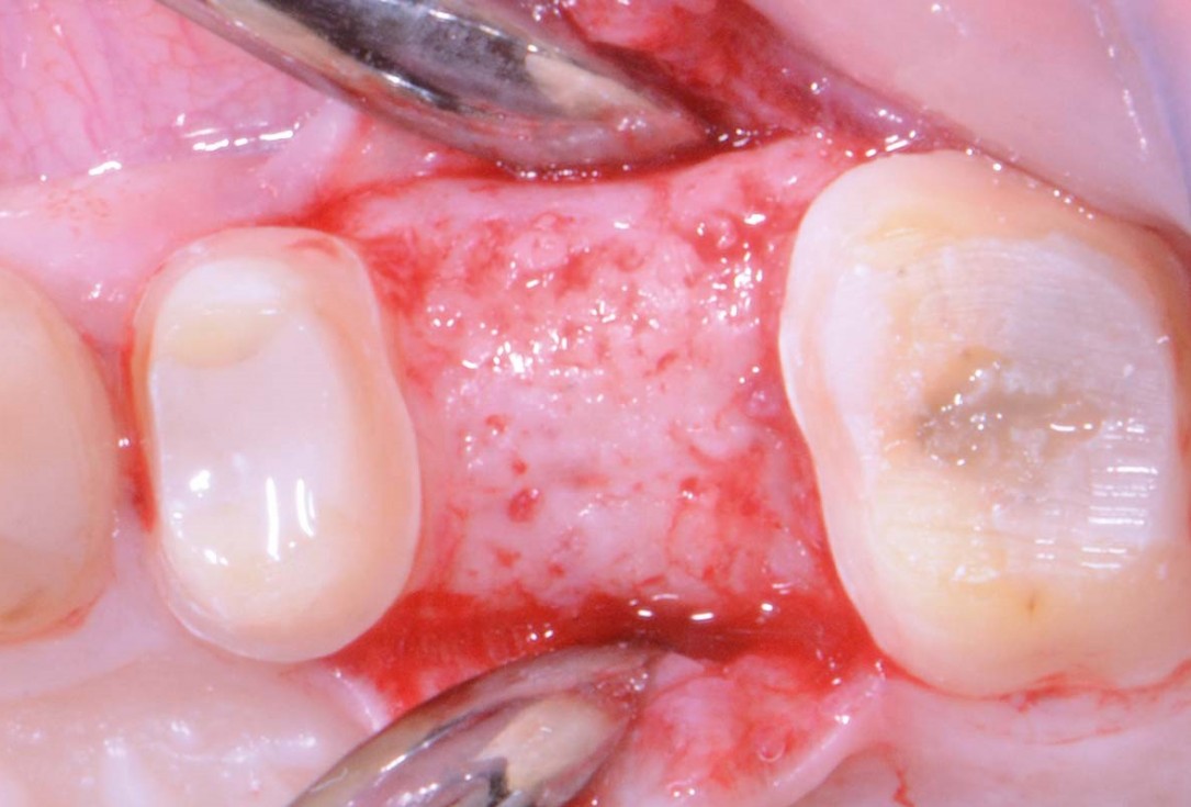 Full bone regeneration in extraction socket augmented with maxgraft® and Jason® membrane – Dr. C. Landsberg