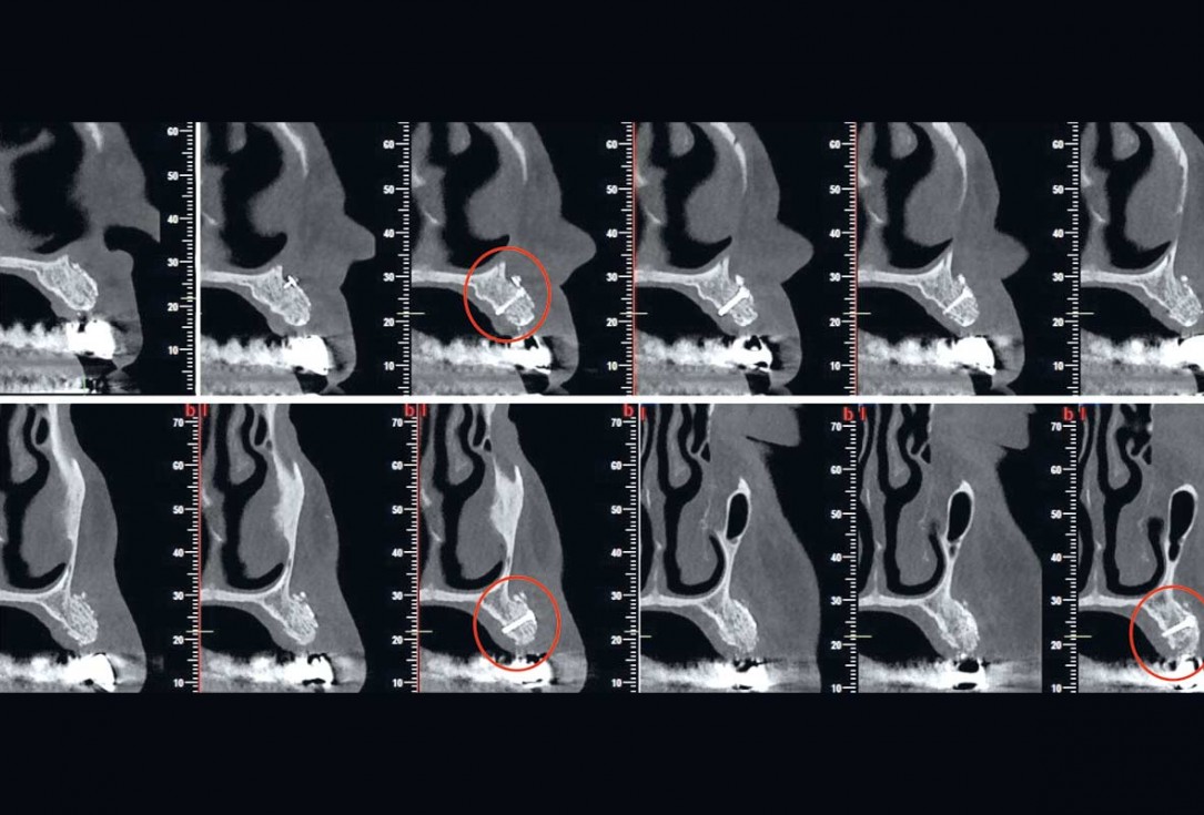 Reconstruction of Anterior Maxilla with maxgraft® bonebuilder – Dr. B. Han