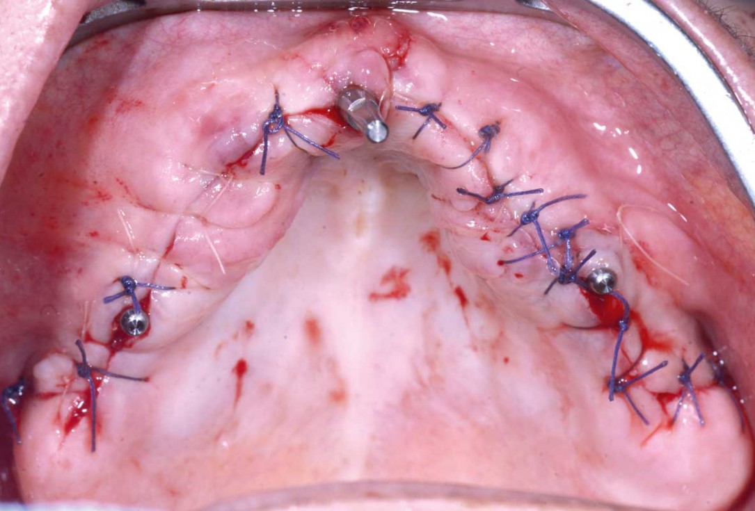 Full arch GBR using botiss cerabone®, maxgraft® and Jason® membrane with simultaneous implantation of 6 Straumann® implants - Dres. A. Signorio and G. Molina
