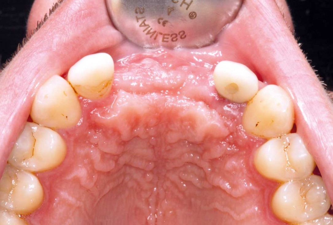 Ridge augmentation in the maxilla with maxgraft® bonebuilder in the aesthetic zone - Dr. M. Kristensen