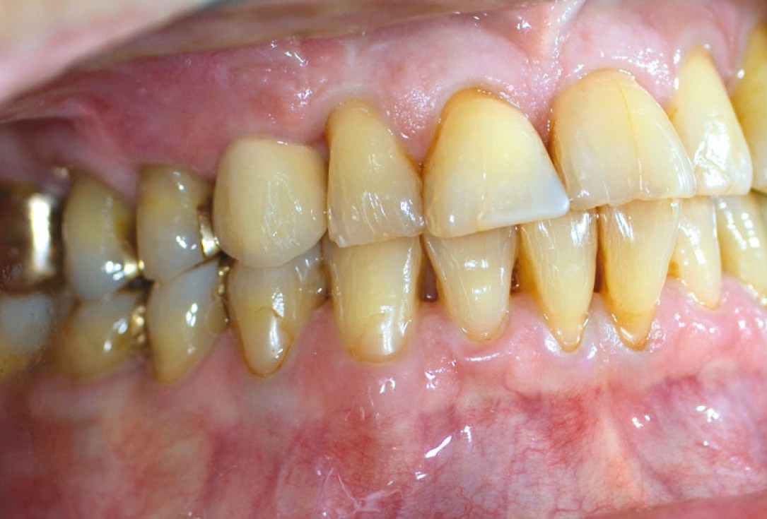 Block augmentation with maxgraft® in the maxilla - PD Dr. Dr. F. Kloss