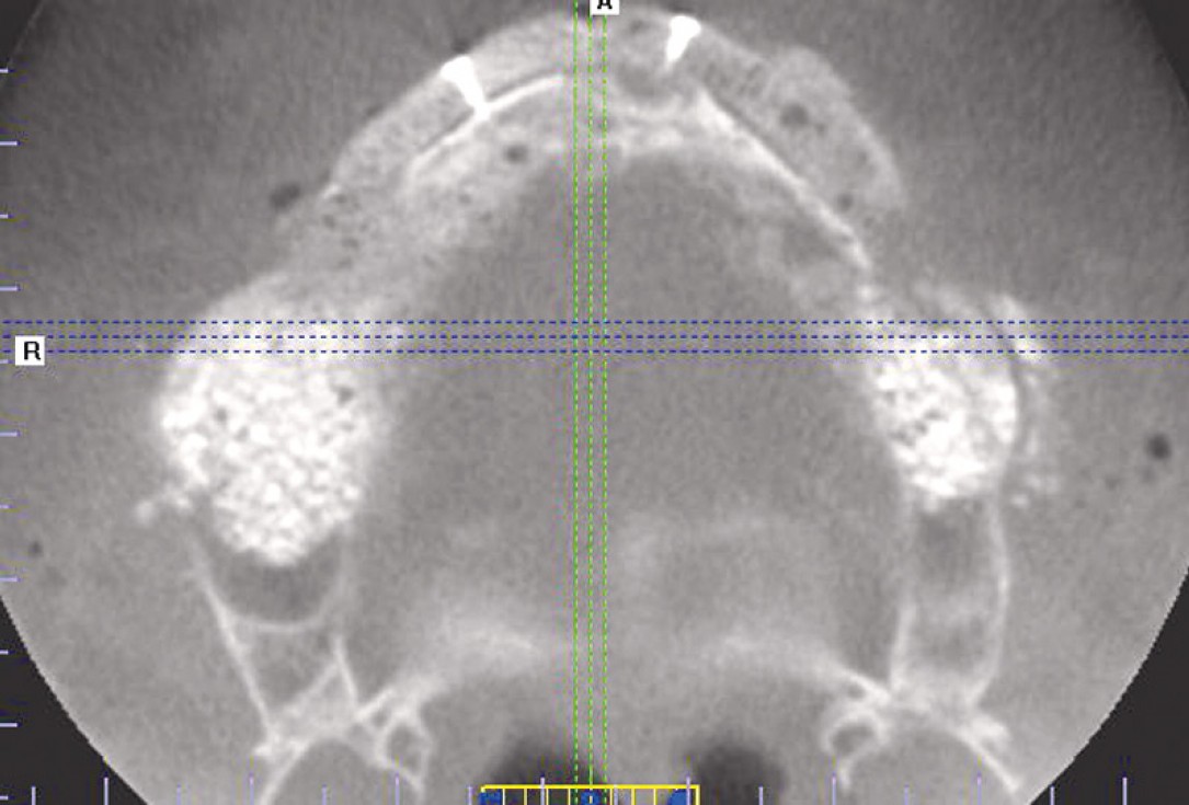 botiss maxgraft® bonebuilder for maxilla reconstruction - Clinical case