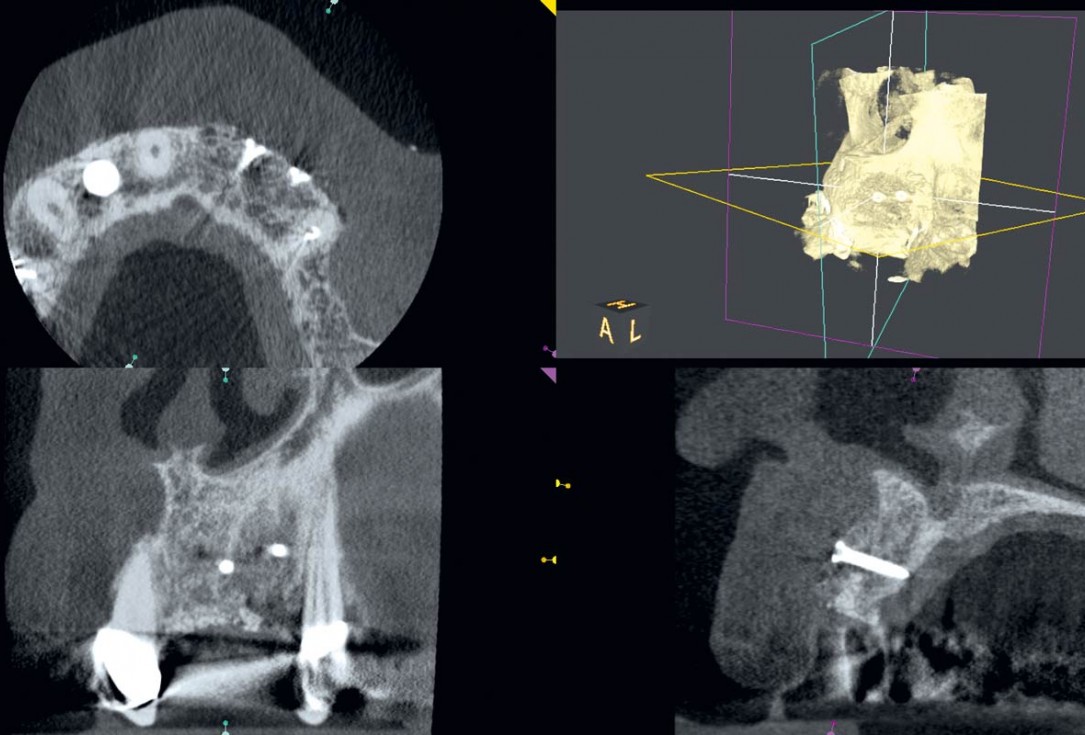 botiss maxgraft® bonebuilder for aesthetic zone reconstruction - Clinical case