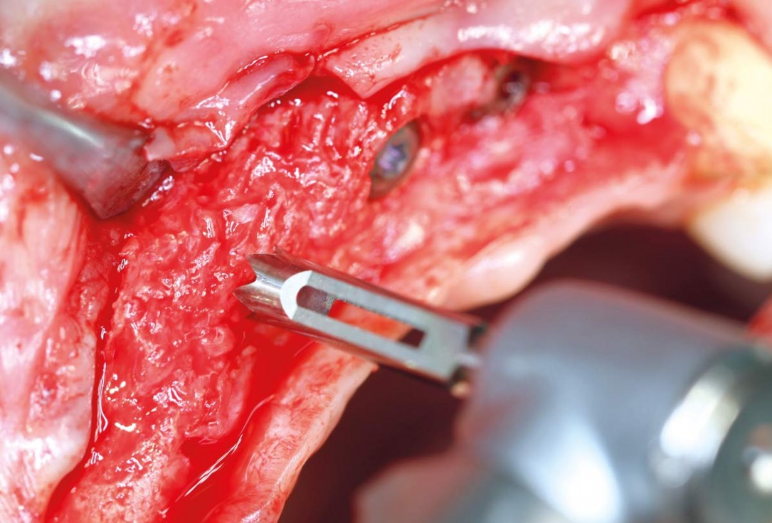 botiss maxgraft® bonebuilder aesthetic reconstruction - Clinical case