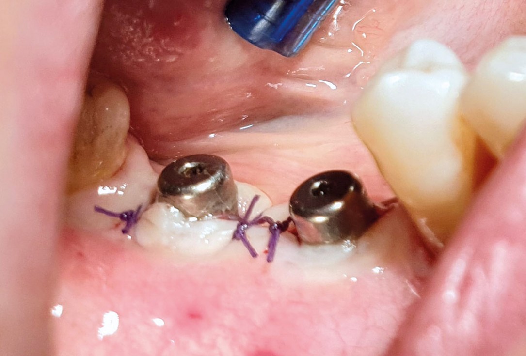 GBR with cerabone® and titanium reinforced PTFE membrane - DentalPro - A. Marchetta