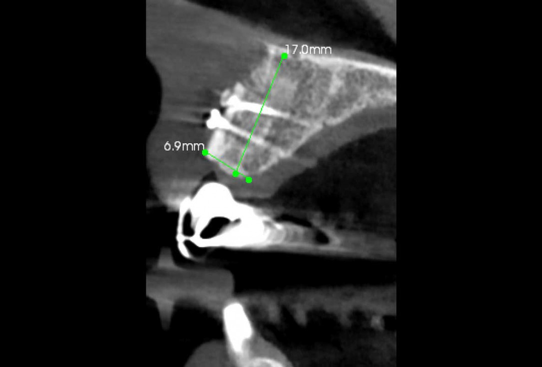 Block grafting in the aesthetic zone with maxgraft®, Jason® membrane and cerabone® - Dres. H. Maghaireh and V. Ivancheva