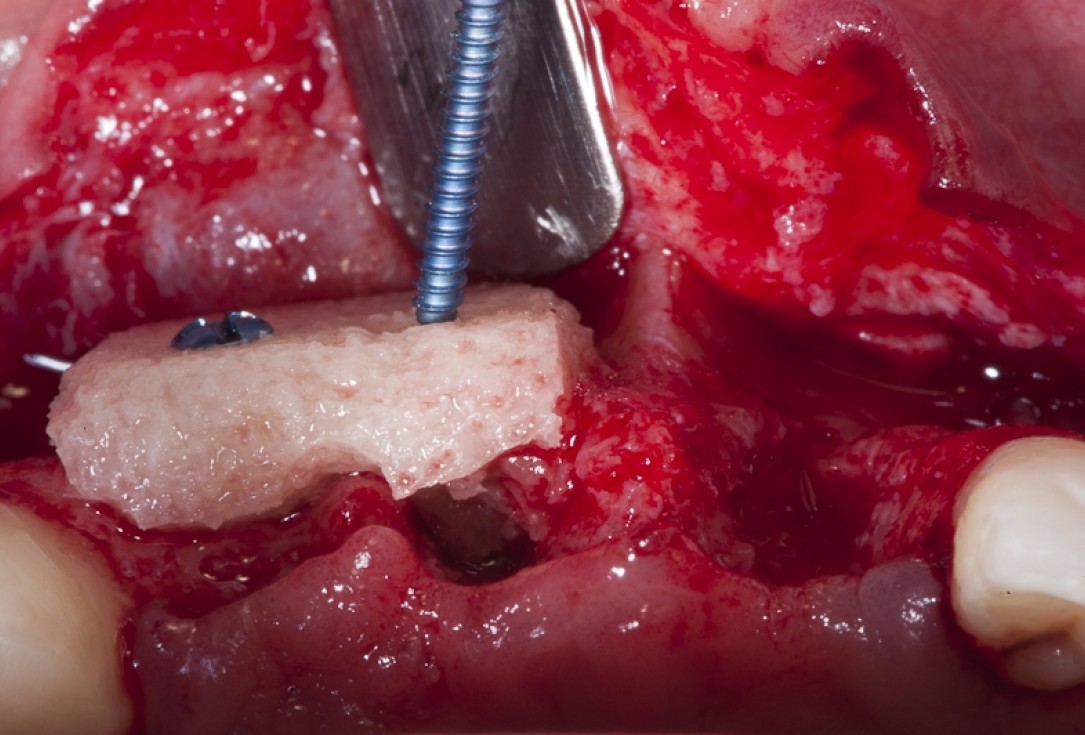 Block augmentation with maxgraft® block and mucoderm® - Dr. K. Chmielewski