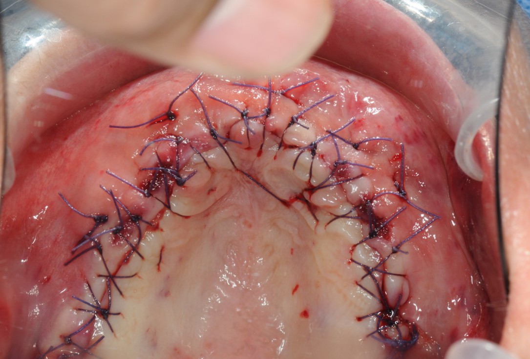 Reconstruction of maxillary ridge with maxgraft® block - Amit Patel
