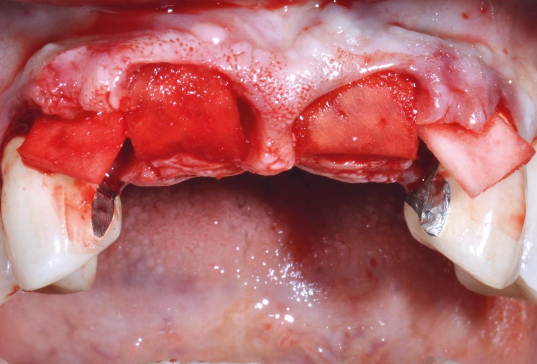 Hard and soft tissue management in immediate restoration