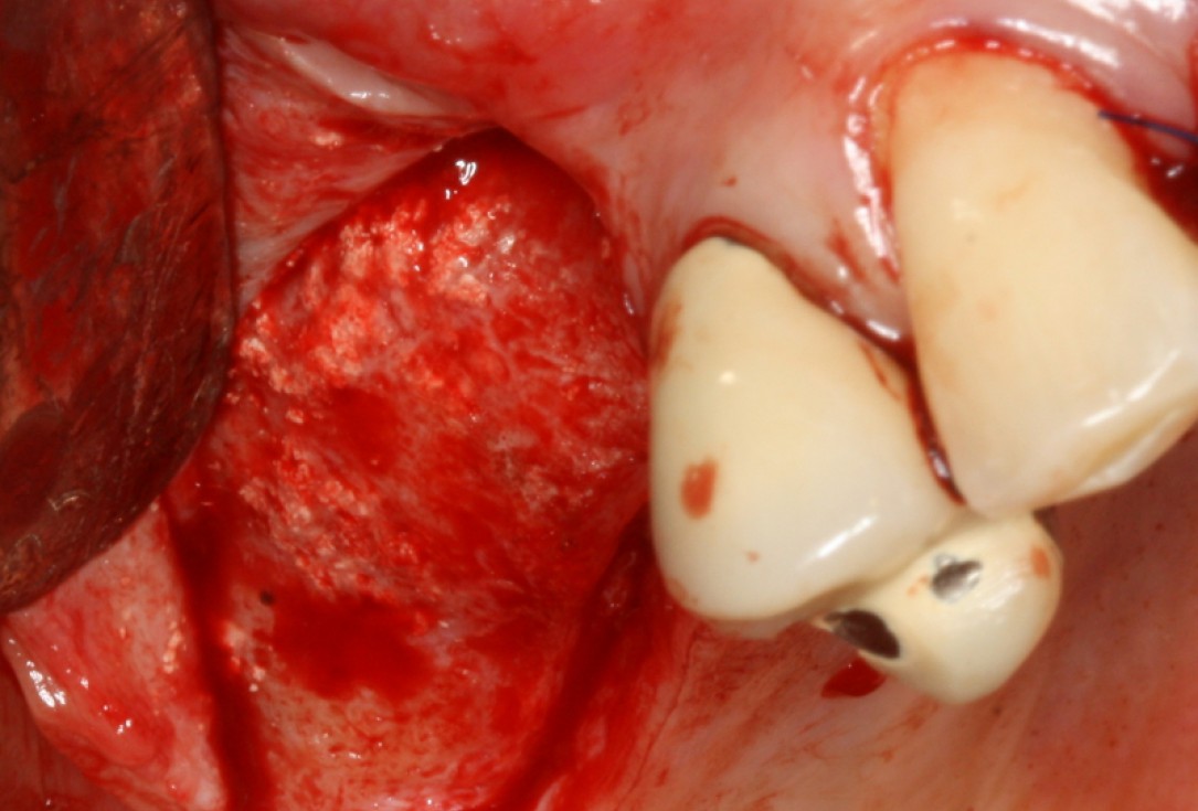 12/20 GBR with maxresorb® and Jason® membrane - Prof. Dr. Dr. D. Rothamel