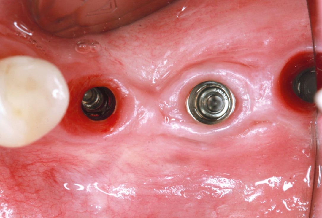 maxgraft® cortico at free-end situation in the mandible - J. Kielhorn