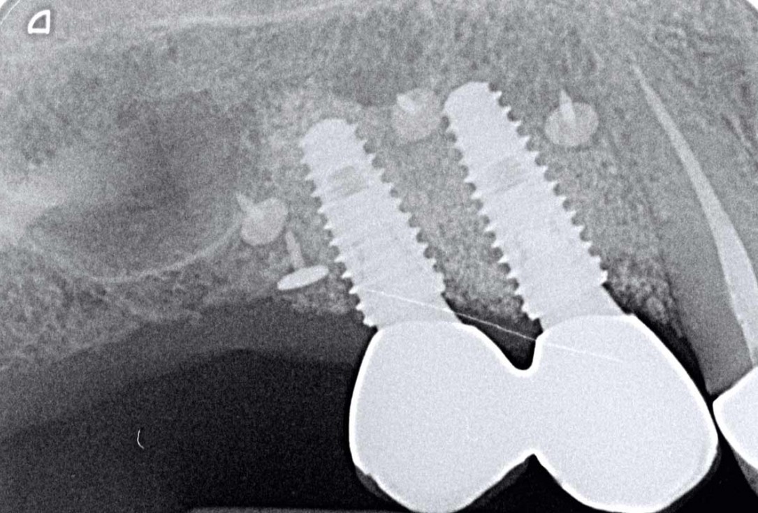 GBR with Jason membrane® and cerabone® - D. Fontana