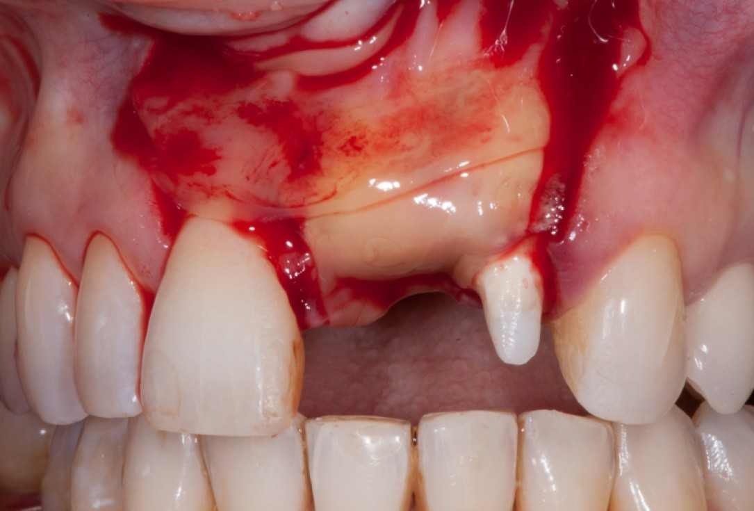 Augmentation with maxgraft® cortico - Dr. K. Chmielewski