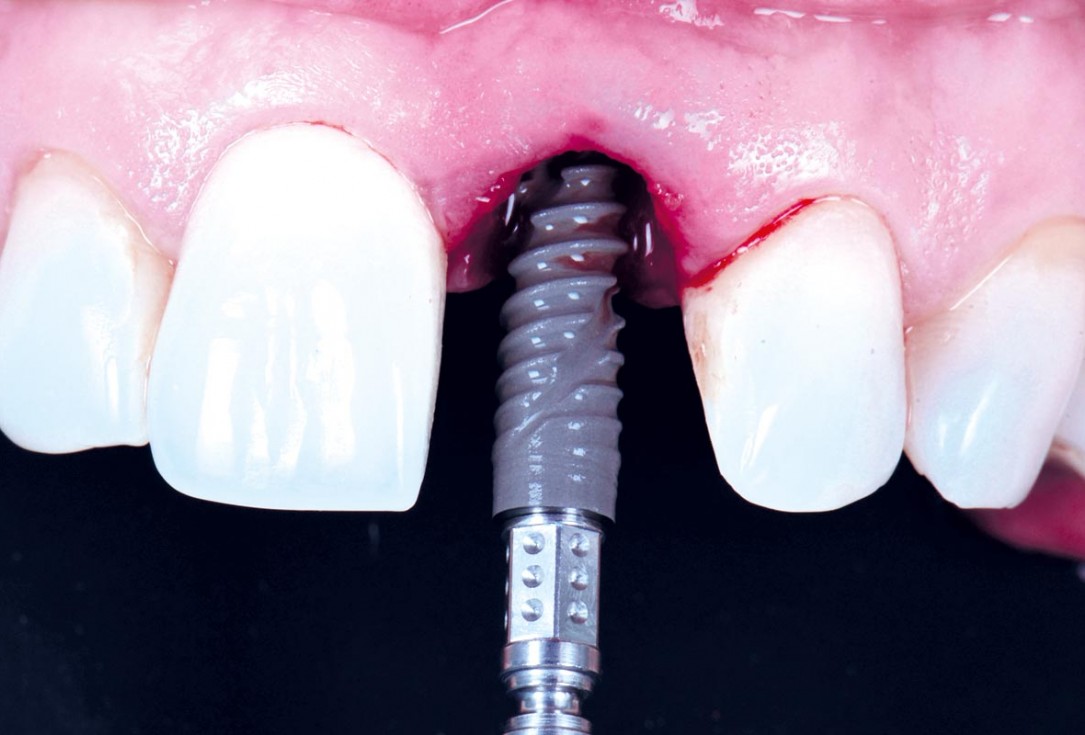 Excellent aesthetic result of buccal augmentation with mucoderm® and maxgraft® after immediate implant placement - 3-years follow-up - Dr. A. Puišys 