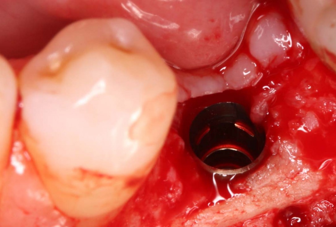 Reconstruction of a single tooth defect with the shell technique - Dr. Andoni Jones
