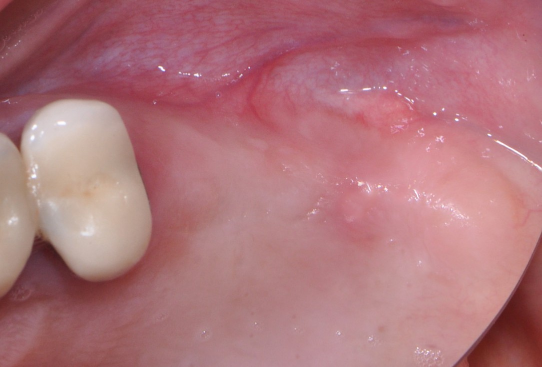 Sinus lift with simultaneous implantation with cerabone® and collprotect® membrane - clinical case Dr. Victor Kalenchuk