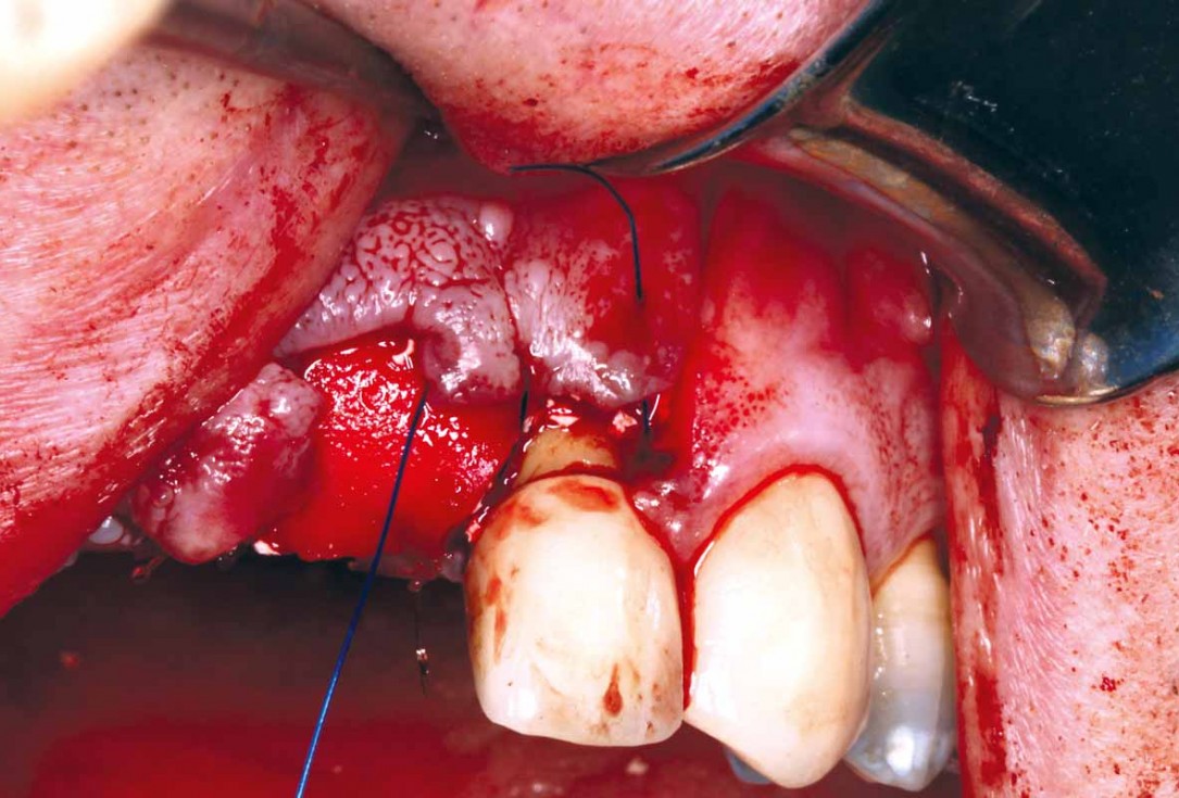 GBR and soft tissue augmentation with cerabone® and mucoderm® - H. Maghaireh & V. Ivancheva