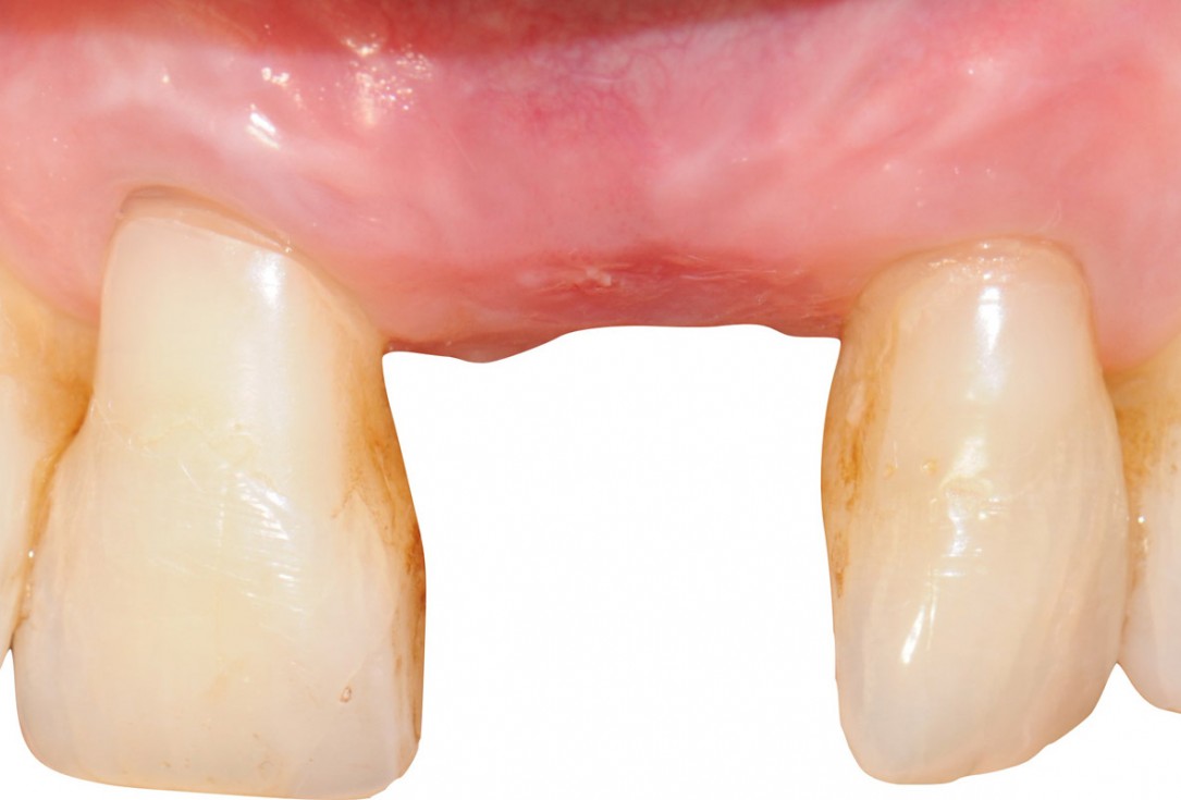 13/18 Tooth extraction and socket sealing with mucoderm® - Dr. A. Rossi