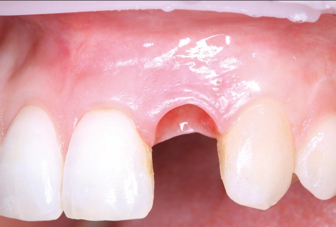 Simultaneous GBR and implantation using maxgraft® granules and autologous bone