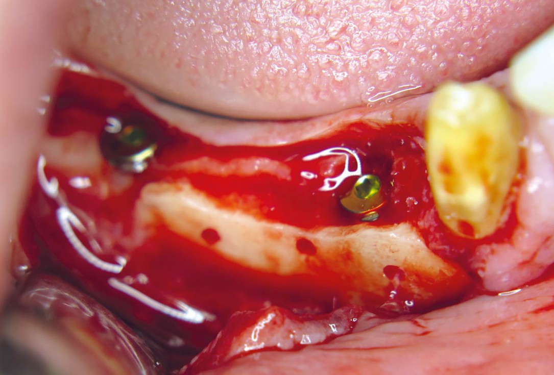 Horizontal ridge augmentation with maxgraft® cortico - M.Sc. E. Kapogianni