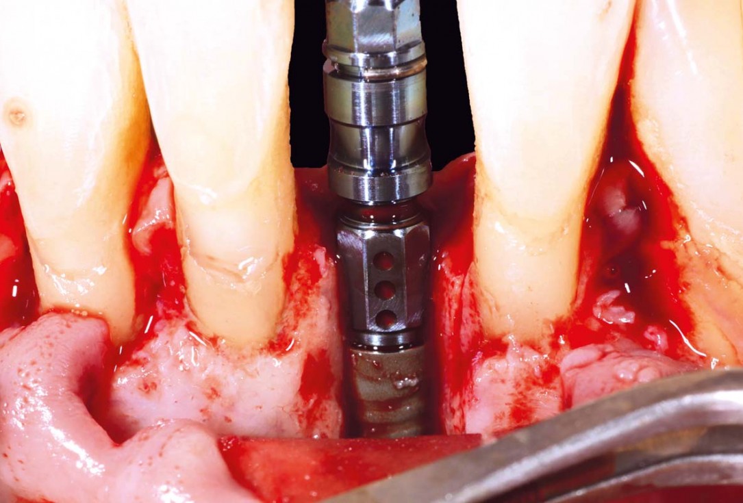 botiss cerabone and mucoderm for bone regeneration and implant supported rehabilitation of a periodontally involved incisor - clinical case